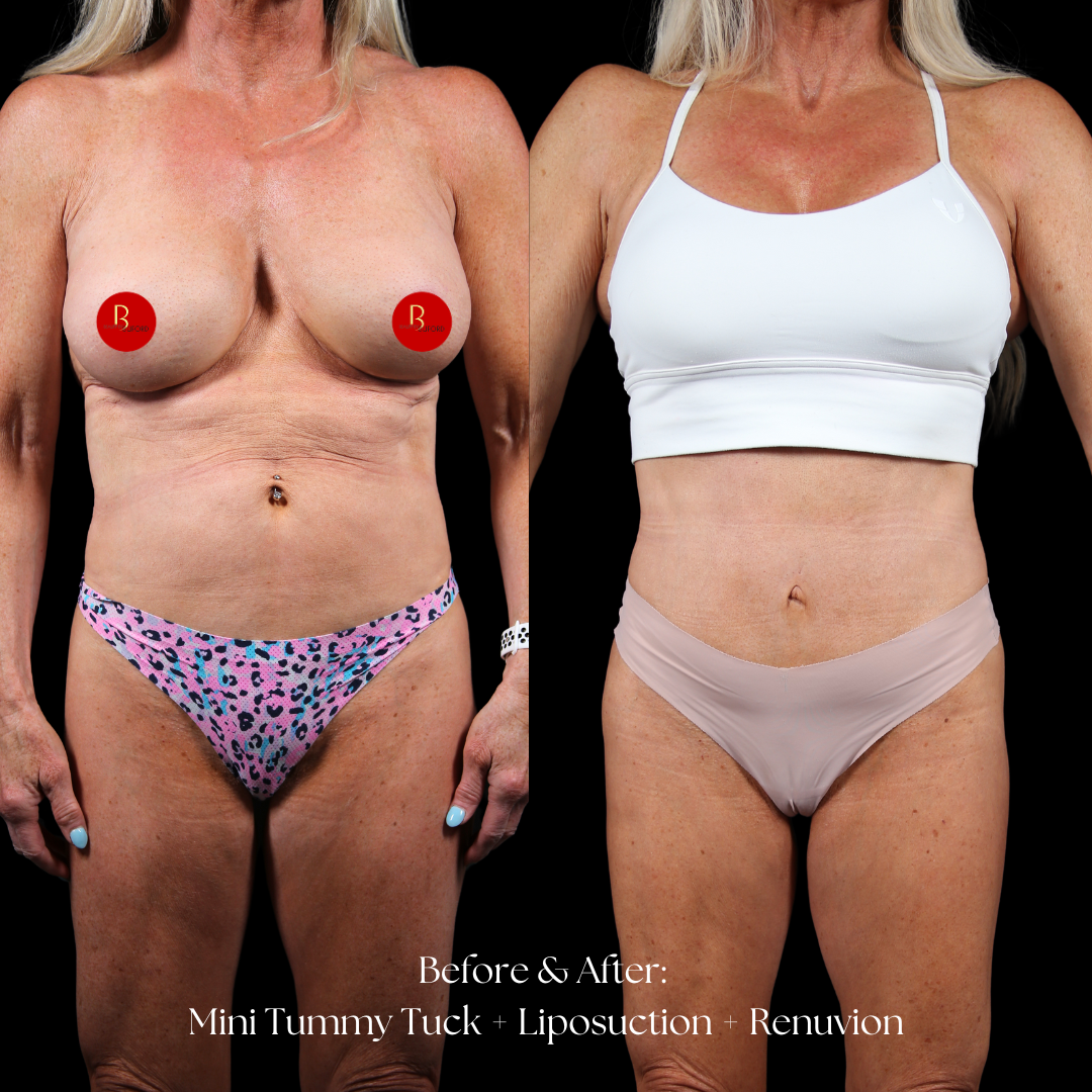 Tummy Tuck Before & After