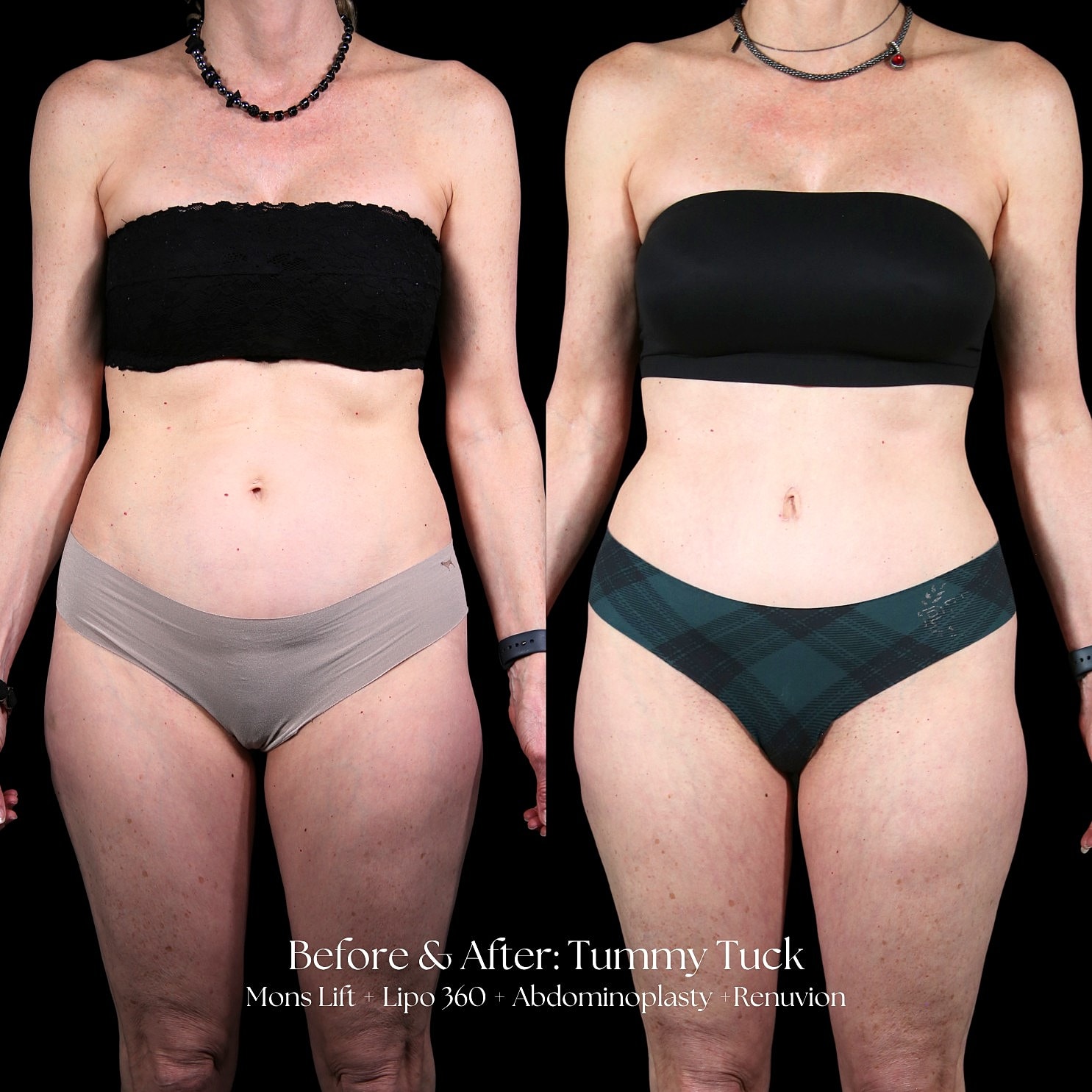 Tummy Tuck Before & After