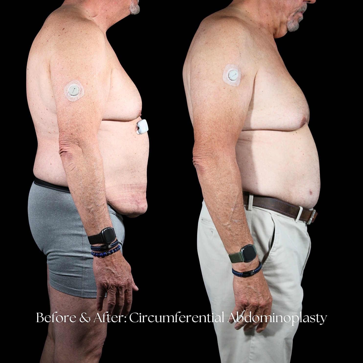 Tummy Tuck Before & After