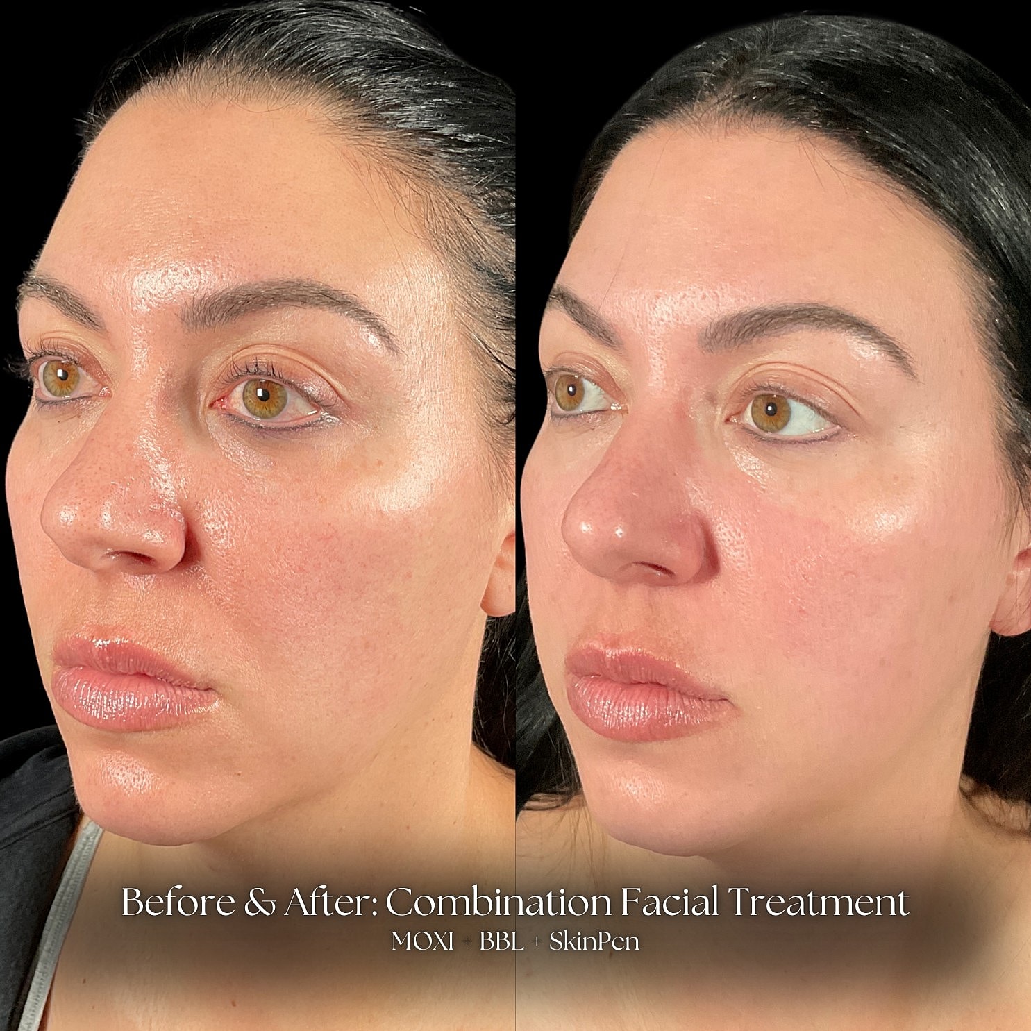 Microneedling Before & After