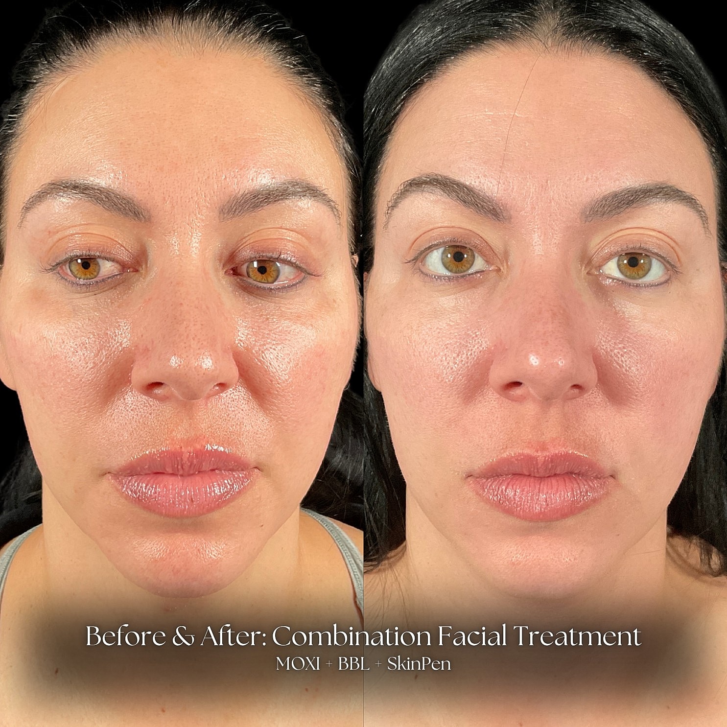 Microneedling Before & After