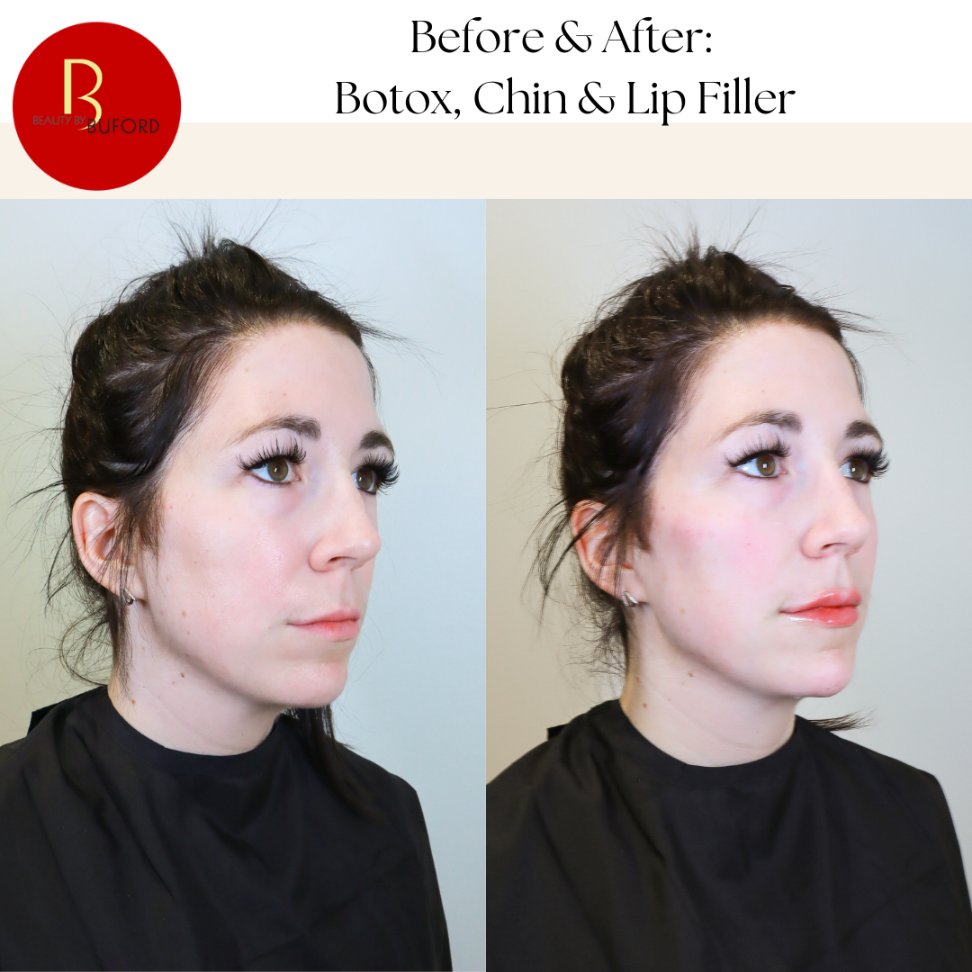 Injectables Before & After
