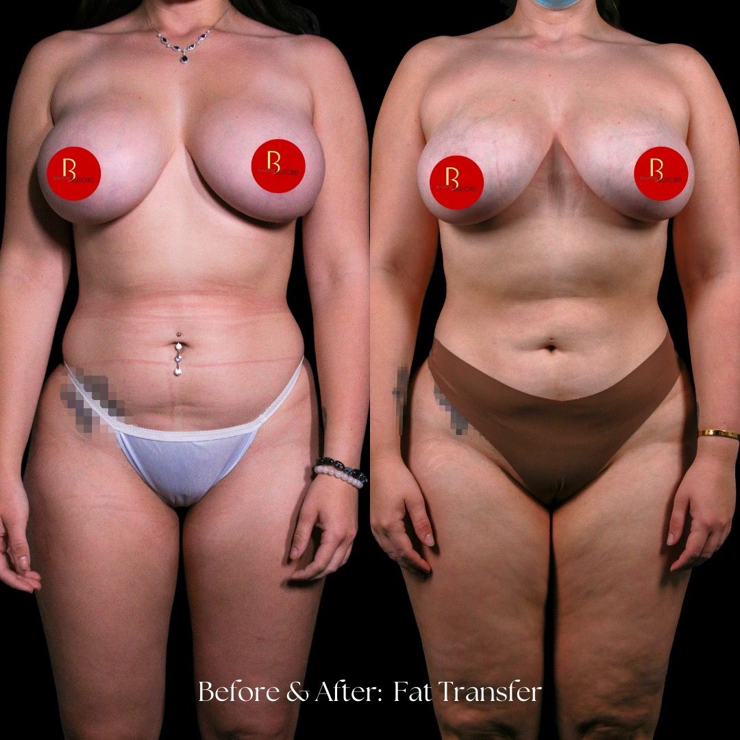 Breast Fat Transfer Before & After