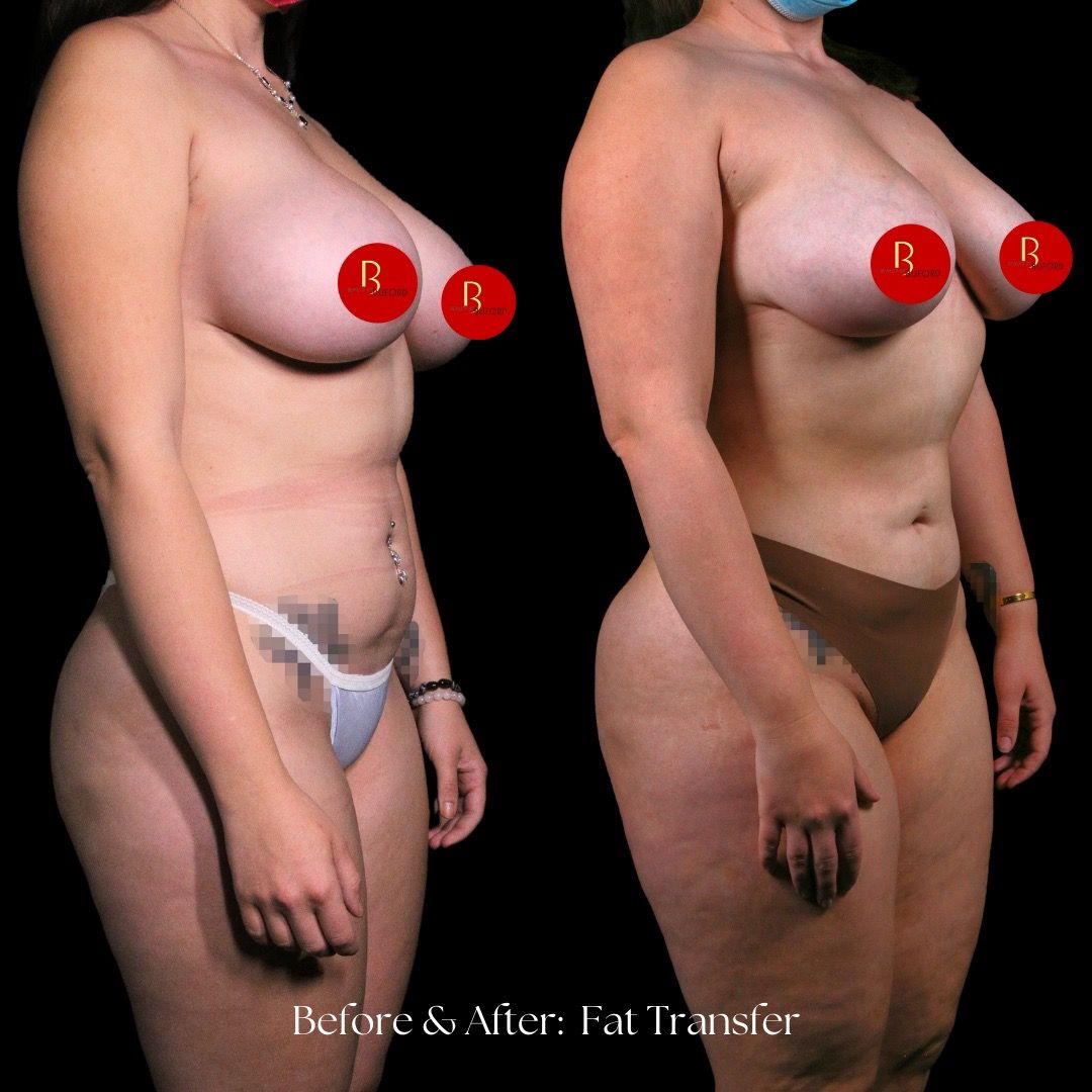 Breast Fat Transfer Before & After