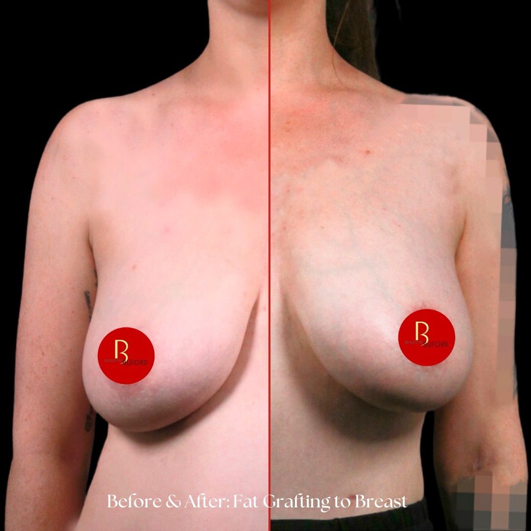 Breast Fat Transfer Before & After